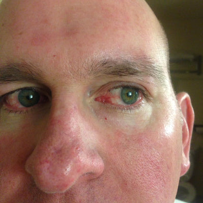 Does CBD make your eyes red?
